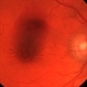 Ruptured Macroaneurysm in a 68-Year-Old Man - Color Photograph