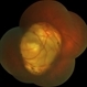 Coloboma of Optic Nerve Coloboma of Optic Nerve
