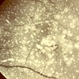 Primary Hyperoxaluria and Oxalosis