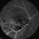 Non-perfused BRVO with macular infarction