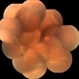 Large retinal dialysis with retinal detachment