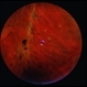 Angioma from Chronic Retinal Detachment Angioma from Chronic Retinal Detachment