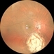 Choroidal Coloboma Choroidal Coloboma