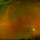 Bullous Retinoschisis with Outer Retinal Holes Bullous Retinoschisis with Outer Retinal Holes