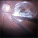 Posterior Vitreous Detachment Posterior Vitreous Detachment