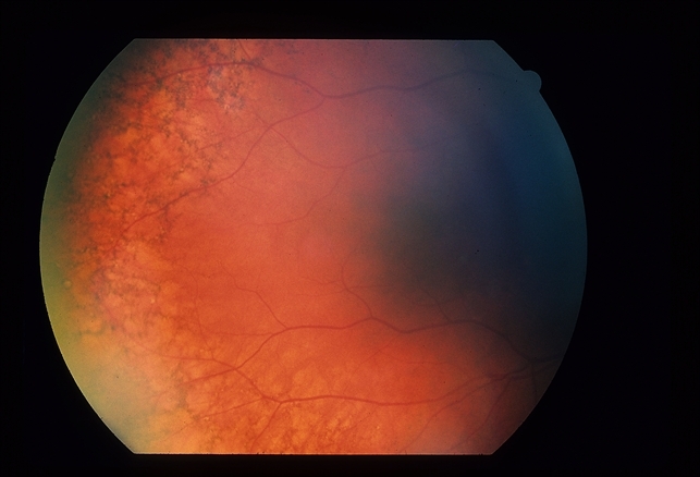 RPE Reticular Degeneration - Retina Image Bank