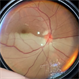 Superior Hemi-Central Retinal Artery Occlusion