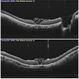 Inverted ILM flap in RD with FTMH-First Post Op Day Inverted ILM flap in RD with FTMH-First Post Op Day