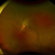 HIV retinopathy