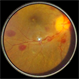 Roth Spots : Smartphone Fundus Image Roth Spots : Smartphone Fundus Image