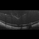 Vitreous Hemorrhage (Floater Storm) Vitreous Hemorrhage (Floater Storm)
