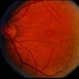 Macular Hole Evolving / Lamellar Hole Macular Hole Evolving / Lamellar Hole