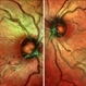 Multicolor Imaging of Bilateral Branch Retinal Vein Occlusion Multicolor Imaging of Bilateral Branch Retinal Vein Occlusion