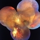 Perforating Ocular Trauma and Choroidal Rupture due to Shotgun Pellet