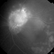 Von Hippel-Lindau (FA Late Phase)