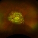 Myopic Degeneration Myopic Degeneration