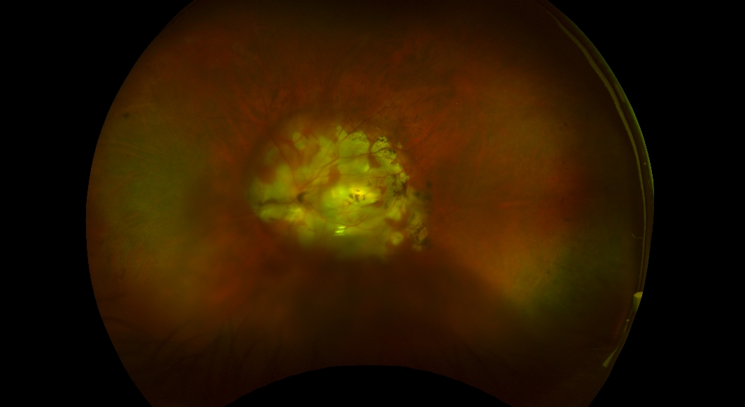 degenerative myopia retina degenerative myopia retina