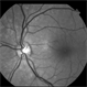 Polypoidal Choroidal Vasculopathy