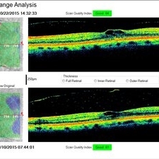 Hypertensive Emergency and Spontaneous Release of VMT - Retina Image Bank