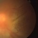 Acute Retinal Necrosis Acute Retinal Necrosis
