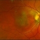 01 Unilateral Acute Idiopathic Maculopathy (UAIM) Pseudocolor Photograph OD 01 Unilateral Acute Idiopathic Maculopathy (UAIM) Pseudocolor Photograph OD