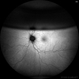 Intraocular Gas bubble - Wide field Fundus Autofluorescence Intraocular Gas bubble - Wide field Fundus Autofluorescence