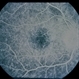 Ring 17 Chromosome Ring 17 Chromosome