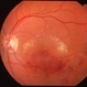 Branch Retinal Vein Occlusion with Macular Edema Branch Retinal Vein Occlusion with Macular Edema