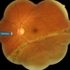Retinal detachment