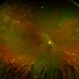 Stage 3 Vogt-Koyanagi-Harada (VKH) Disease