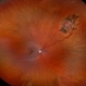 Reactive Retinal Astrocytic Tumor Reactive Retinal Astrocytic Tumor