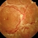 Proliferative Diabetic Retinopathy - PDR Proliferative Diabetic Retinopathy - PDR
