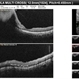 Idiopathic Intracranial Hypertension Idiopathic Intracranial Hypertension