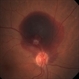 Macroaneurysm - Fundus Image