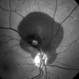 Macroaneurysm - Red Free