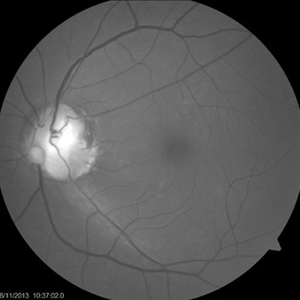 Optic Nerve Coloboma and 2 Pits Nasal and temporal - Retina Image Bank