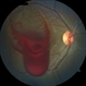 YAG-Hyaloidotomy for Subhyaloid Hemorrhage YAG-Hyaloidotomy for Subhyaloid Hemorrhage