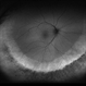 Pigmentary Retinal Dystrophy Pigmentary Retinal Dystrophy