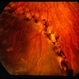 Angioma from Chronic Retinal Detachment Angioma from Chronic Retinal Detachment