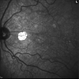 Pentosan Maculopathy Red Free Photo Left