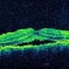 Idiopathic Uveal Effusion Syndrome Idiopathic Uveal Effusion Syndrome