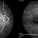 Stereo View of Retinal Angiomatous Proliferation in Age-Related Macular Degeneration