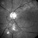 Proliferative Diabetic Retinopathy With Neovascularization - Red-Free
