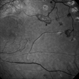 Proliferative Diabetic Retinopathy With Neovascularization - Red-Free