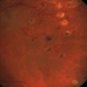 Proliferative Diabetic Retinopathy With Neovascularization - Fundus photograph