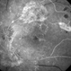 Proliferative Diabetic Retinopathy With Neovascularization - FA