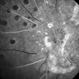 Proliferative Diabetic Retinopathy With Neovascularization - FA