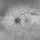 Blister Retinal Detachment Superotemporal with a Flap Tear Blister Retinal Detachment Superotemporal with a Flap Tear