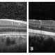 Paracentral Acute Middle Maculopathy Paracentral Acute Middle Maculopathy