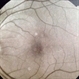 Choroidal Hemangioma